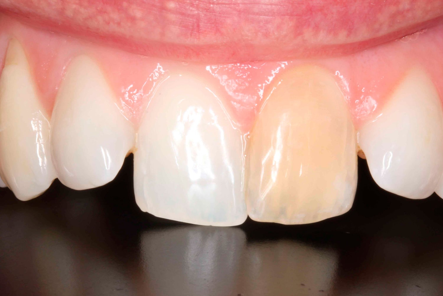 Cambio de color en un diente